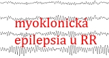 myoklonicka epilepsia RR