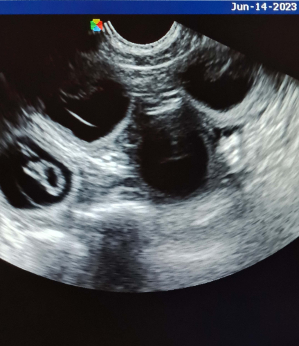 Pregnancy Nessy 2023